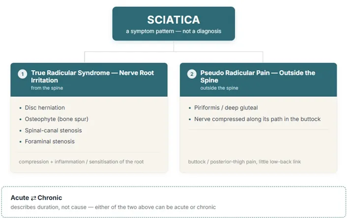 Classification of sciatica types and causes